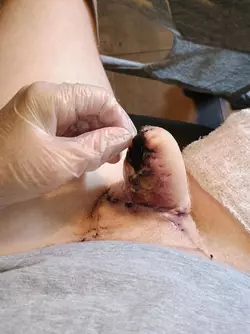 11-weeks-post-op-update-evolution-of-my-weenie-v0-d59tay8imuif1.webp
