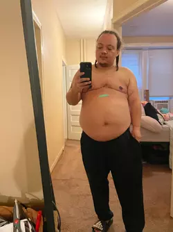 almost-3-weeks-post-op-v0-6gkeche0y0of1.webp
