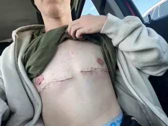 weird-incision-shape-3-weeks-po-v0-1oxu70oa76of1.webp