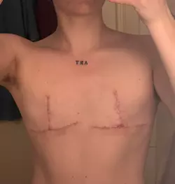 rant-and-my-full-top-surgery-story-now-finally-happy-3-v0-mp0rm3vjptof1.webp