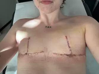 rant-and-my-full-top-surgery-story-now-finally-happy-3-v0-17rbp3vjptof1.webp