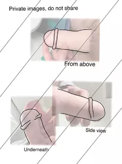 norfolk-glansplasty-without-skin-graft-pictures-v0-gc5ptsducjof1.webp