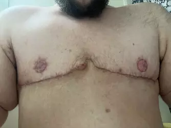 4-weeks-post-op-di-v0-1q1dsskspfqf1.webp