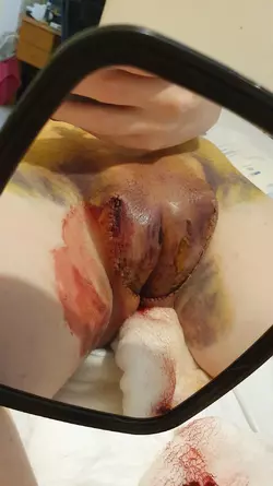 post-operative-of-my-vaginoplasty-3-years-ago-v0-mdfvsng08svf1.webp