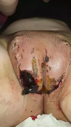 post-operative-of-my-vaginoplasty-3-years-ago-v0-o5c0jng08svf1.jpg