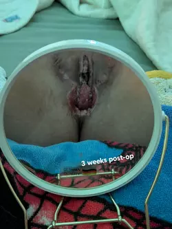 1-month-modified-pi-srs-post-op-basel-former-mijuskovic-team-v0-dr3z4abzihuf1.webp