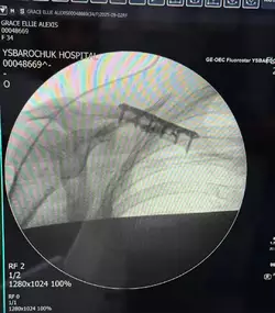 clavicle-reduction-v0-m94hnu7m0xxf1.jpg