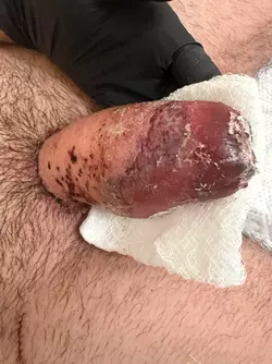 graphic-pictures-of-course-of-tissue-loss-v0-0cylc5p9634g1.webp