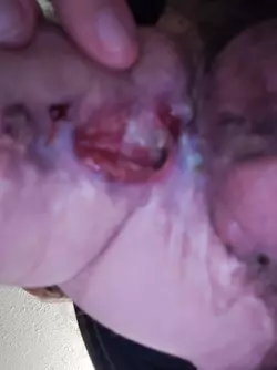 huge-urethrocutaneous-fistula-v0-4ay44khllqzf1.webp