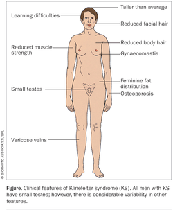 F-Klinefelter syndrome-Upreti.jpg