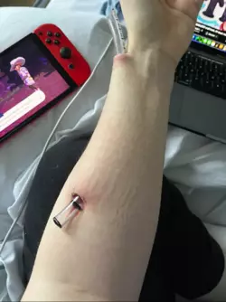 9 days of IV antibiotics for pseudomonas later, looked better, still oozing a bit though.