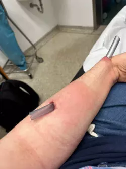 Five days later, different hospital, infection was back in full force. Systemic infection, pus, swelling, excrutiating pain. IV antibiotics started again.