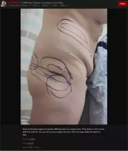 scrubby - body contouring surgery 005.png