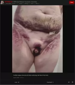 scrubby - body contouring surgery 006.png