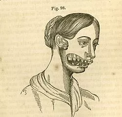 Phossy_jaw.jpg