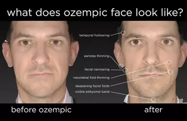 Male Ozempic Face.webp