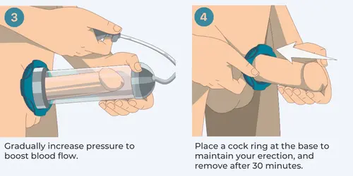 Penis pump.webp