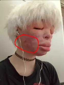 potential-bone-scar.png