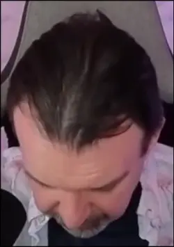 BALD.png
