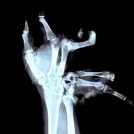 Broken Hands