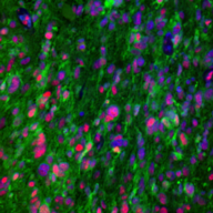 glioblastoma multiforme