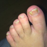 CathysGnarlyFoot